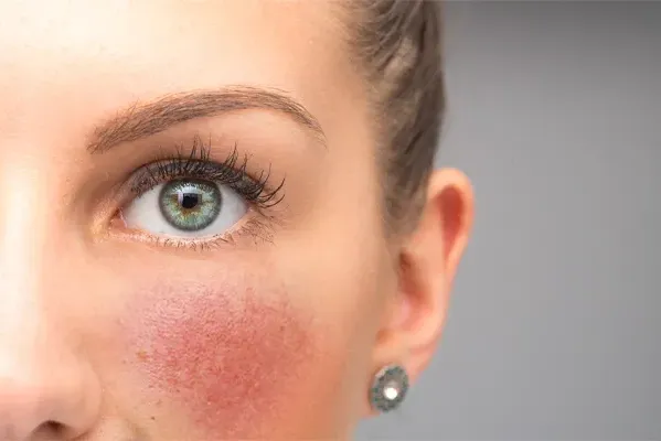 Rosacea-Doctor Close-up of a woman with rosacea on her cheeks. Schedule functional medicine treatment for rosacea from Tasmin Cordie, D.C. of Sage Functional Medicine in Marlboro Township.