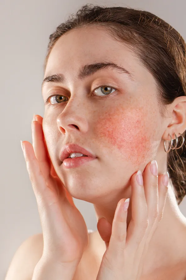 Rosacea-Treatment A women framing her face with her hands while inspecting her Rosacea. Schedule a Functional Medicine consultation for Rosacea by Tasmin Cordie, D.C. of Sage Functional Medicine in Marlboro Township.
